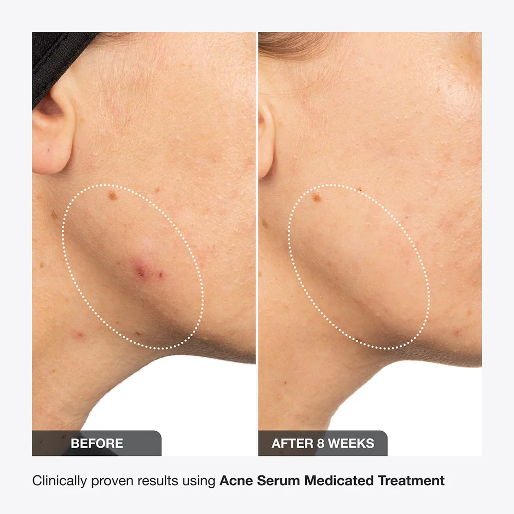 Acne Serum - Image 11
