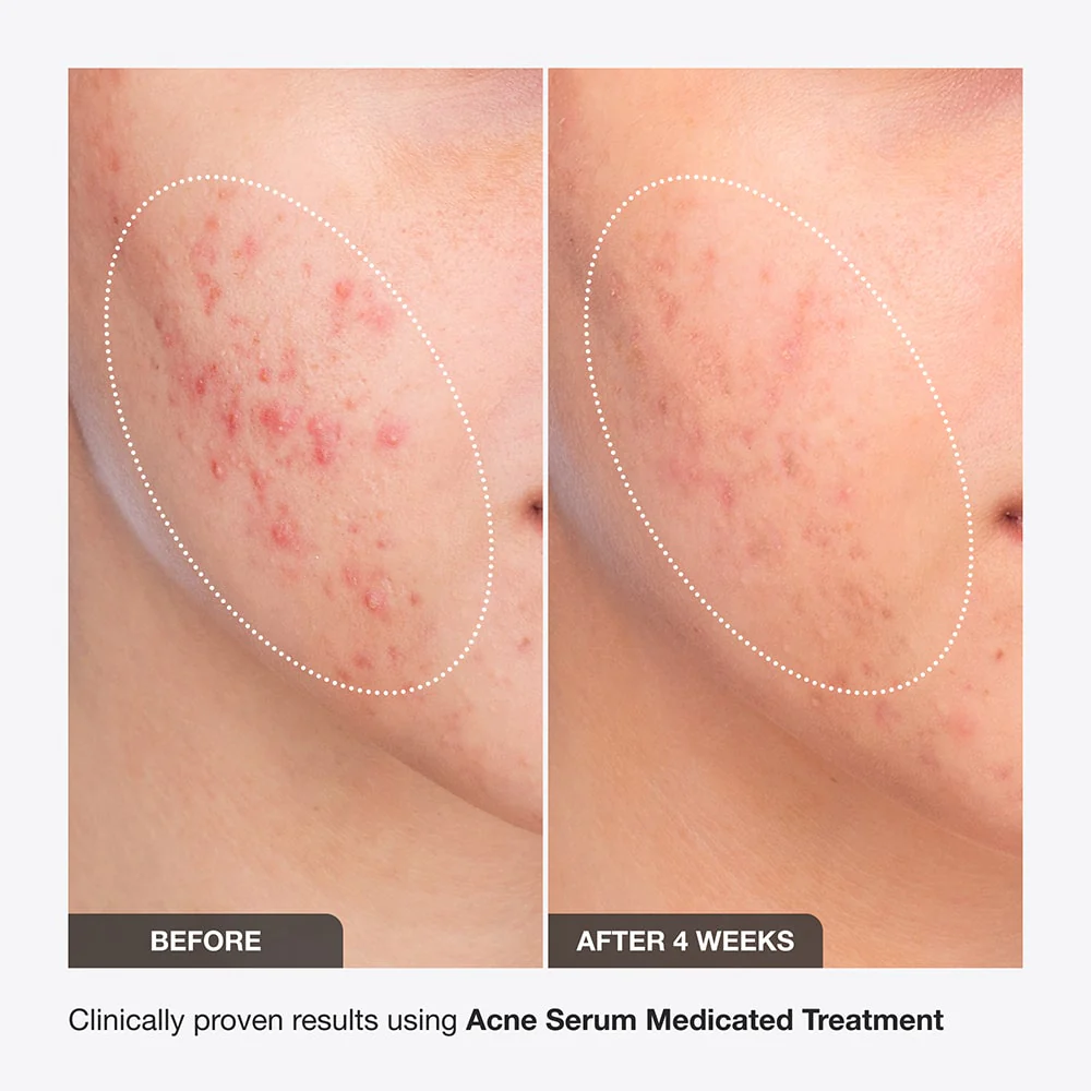 Acne Serum - Image 12