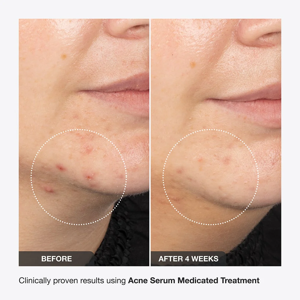 Acne Serum - Image 4