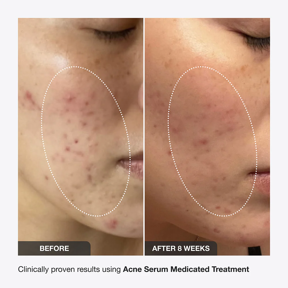 Acne Serum - Image 7